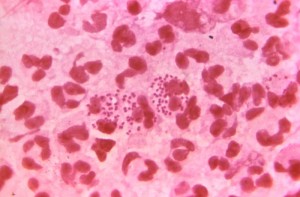 Gonorrhea image/CDC