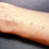 Schistosome dermatitis