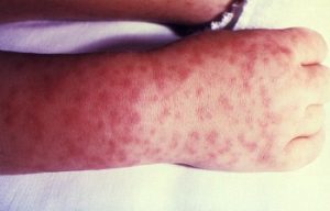 Characteristic spotted rash of Rocky Mountain spotted fever/CDC