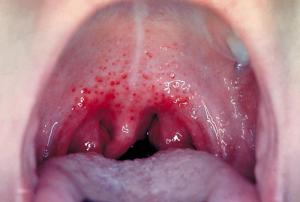 Strep throat is caused by group A Streptococcus bacteria./CDC