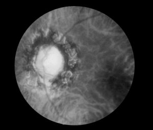 This funduscopic image reveals the effects of late neuro-ocular syphilis on the optic disk and retina/CDC