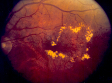 Diabetic macular edema/NIH