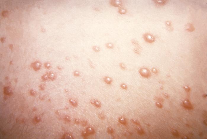 This pustulovesicular rash represents a generalized herpes outbreak due to the Varicella-zoster virus (VZV) pathogen/CDC