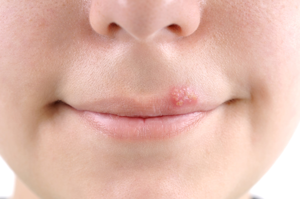 Cold sore/American Academy of Dermatology (Academy)