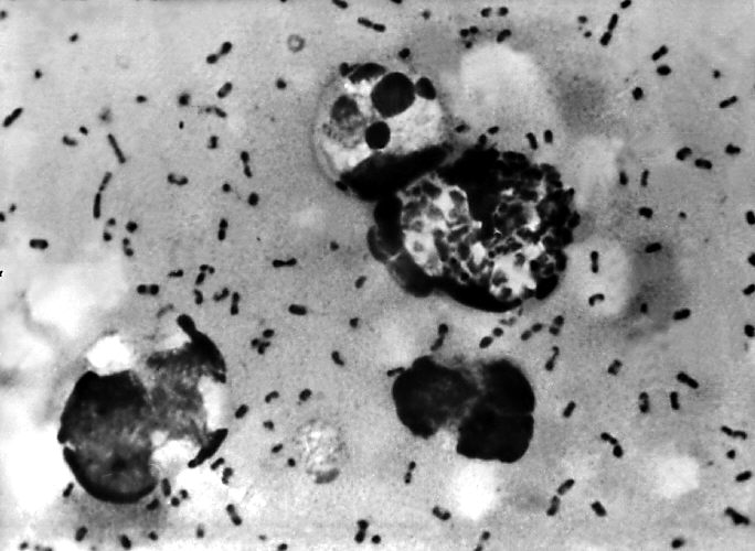 Bipolar staining of a plague smear prepared from lymph aspirated from an adenopathic lymph node, or bubo, of a plague patient./CDC