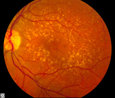 Age-related macular degeneration Credit: National Eye Institute, National Institutes of Health