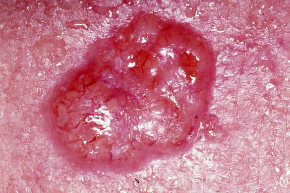 Basal cell carcinoma Image/John Hendrix, MD 