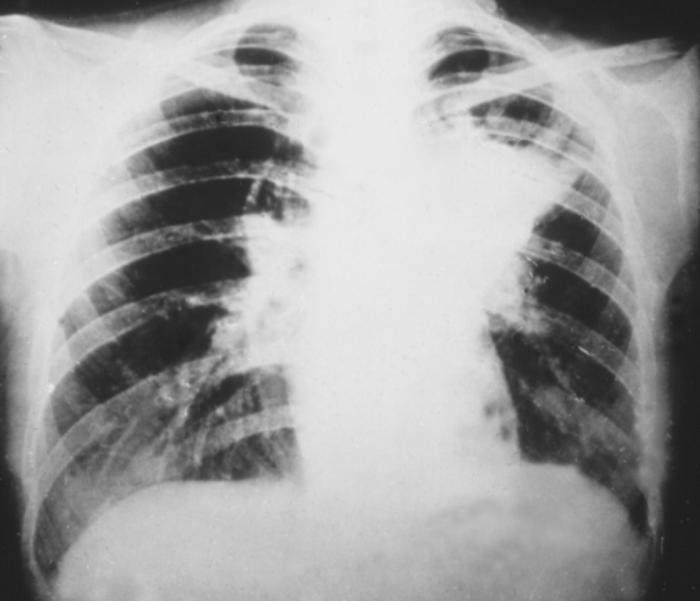 Chest X-ray demonstrates lung infiltrates due to Blastomycosis/CDC