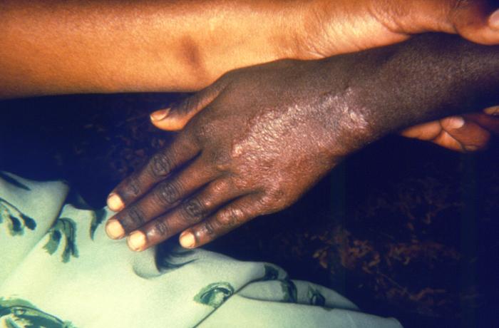 Leprosy/CDC