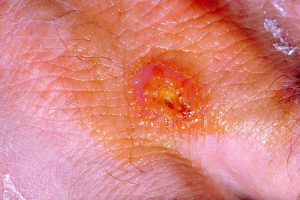 A Tularemia lesion on the dorsal skin of right hand/CDC