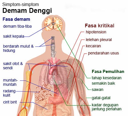 Dengue symptoms/Malaysia Health Ministry