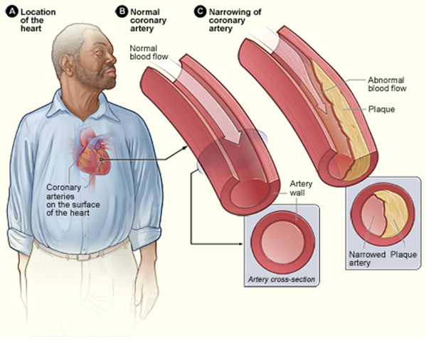 Atherosclerosis as a result of coronary heart disease. Image/National Heart, Lung and Blood Institute