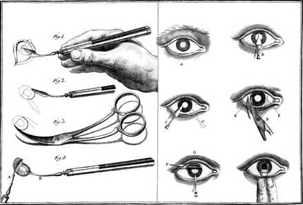  Instruments used in cataract operations. From a 1780 edition of Johannes de Gorter’s Cirugia expurgada. Courtesy Wellcome Library