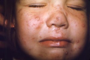 A number of varicella, or chickenpox lesions on the face of a young child/CDC
