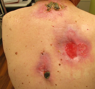 A 70-year-old patient regularly applied black salve to lesions on his back, resulting in ulcerations with cellulitis. Image/American Academy of Dermatology