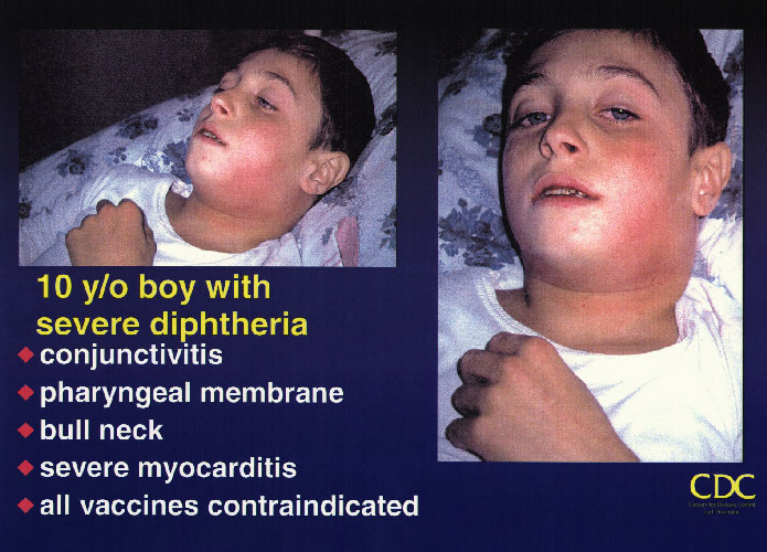 about diphtheria disease
