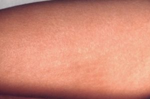 This patient revealed a scarlet fever rash on the volar surface of the forearm due to group A Streptococcus bacteria Image/CDC