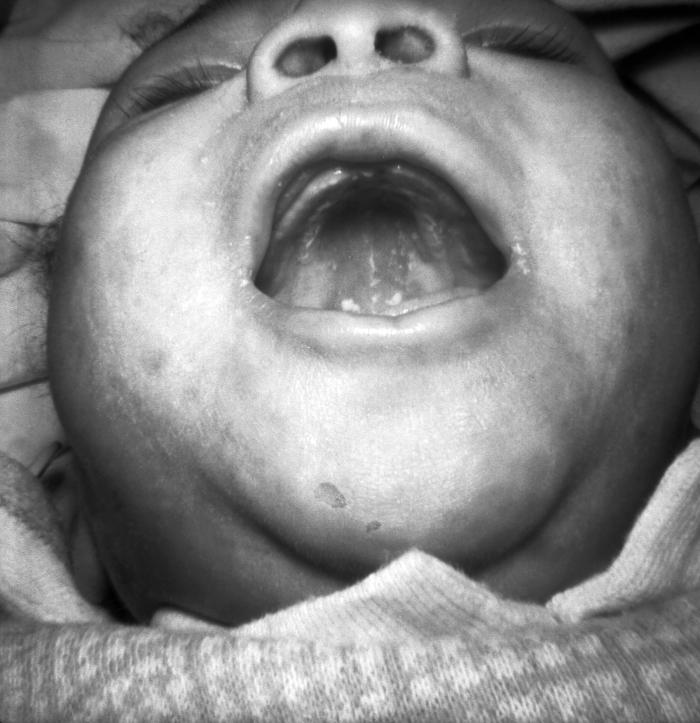 An infant demonstrating mucous patches and skin lesions resulting from congenital syphilis Image/CDC