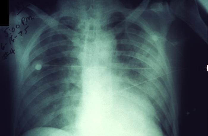 This anteroposterior x-ray reveals a bilaterally progressive plague infection involving both lung fields Image/CDC