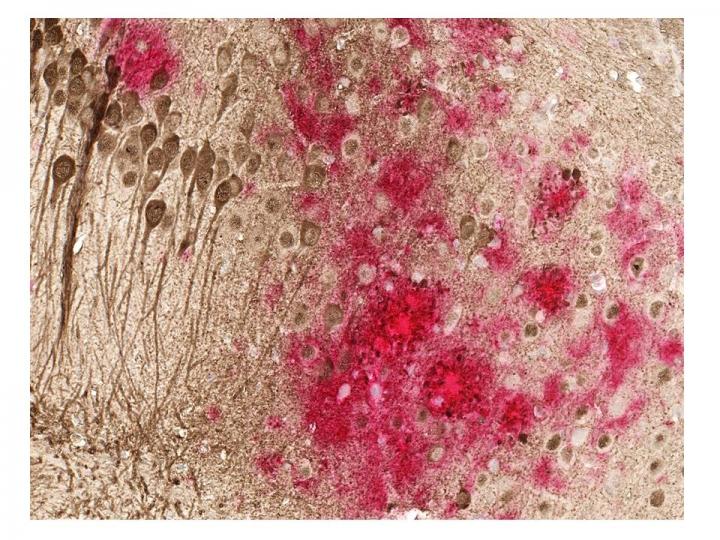Toxic amyloid plaques (red) and tau tangles (brown) form on the brain of a mouse modeled to have Alzheimer's disease. A study shows a DNA vaccine reduces both amyloid and tau in the mouse AD model, with no adverse immune responses. Image/UT Southwestern