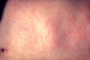 Measles rash Image/CDC