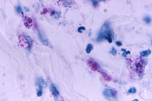 This light photomicrograph revealed some of the histopathologic cytoarchitectural characteristics seen in a mycobacterial skin infection./CDC