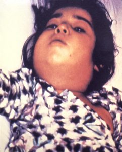 This child with diphtheria presented with a characteristic swollen neck, sometimes referred to as “bull neck”.  Image/CDC