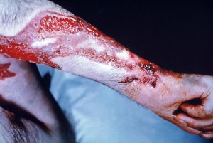This patient’s arm shows the effects of the fungal disease sporotrichosis, caused by the fungus Sporothrix schenckii./CDC