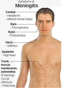 Meningitis symptoms/Public domain image/Mikael Häggström
