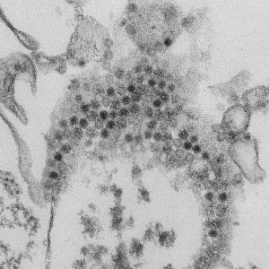 Numerous, spheroid-shaped Enterovirus-D68 (EV-D68) virions/Cynthia S. Goldsmith, Yiting Zhang