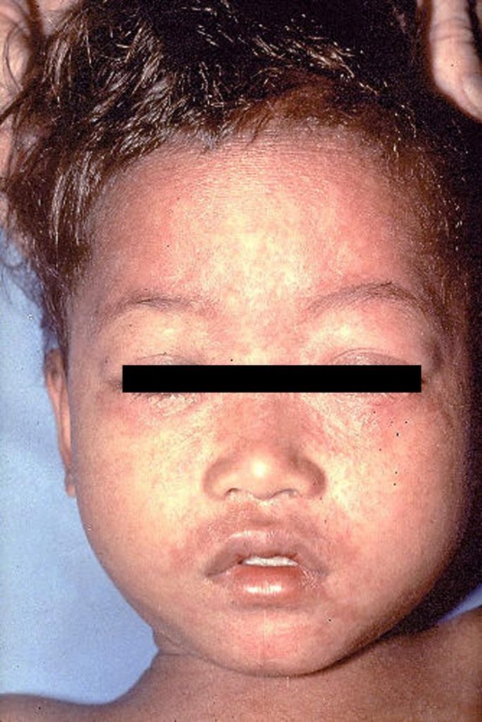 Face of child with measles. Image/CDC
