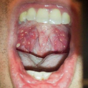 Ulcerous herpangina on soft palete and oropharynx from Hand Foot and Mouth Disease (HFMD) Public domain image/shawn c