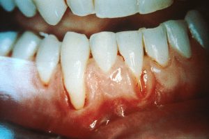 Gum damage caused by the use of smokeless tobacco (chewing tobacco). Image/ National Cancer Institute