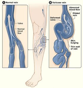 Varicose veins Image/National Heart Lung and Blood Institute