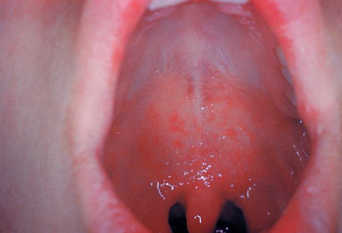 This was a patient who presented with Koplik’s spots on palate due to pre-eruptive measles on day 3 of the illness./CDC