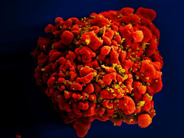Red-colored H9-T cell that had been infected by numerous, spheroid-shaped, mustard-colored human immunodeficiency virus (HIV) particles Image/NIAID