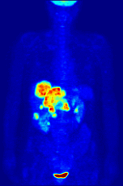 PET scan showing metastases of a colorectal cancer/Public domain image-Jens Maus