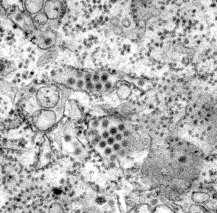 This transmission electron micrograph (TEM) depicts a number of round, Dengue virus particles that were revealed in this tissue specimen/ CDC