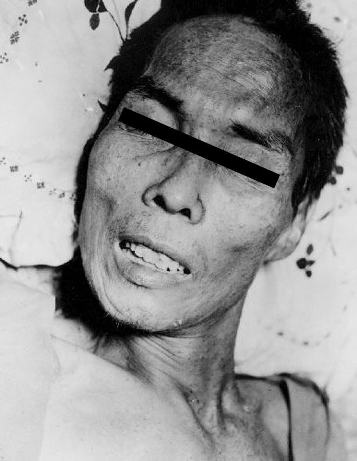 Tetanus in a 46-year-old man, Manila/CDC