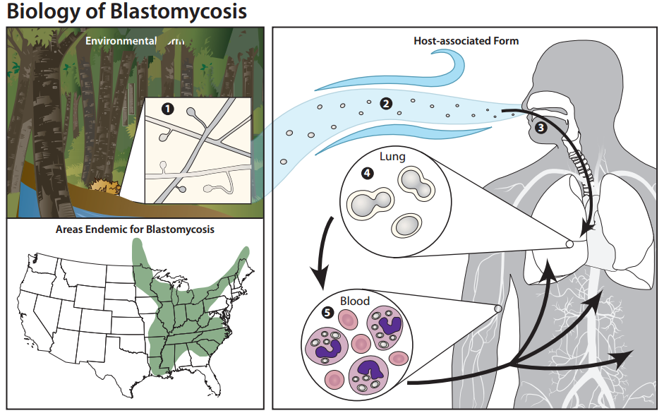 Blastomycosis/CDC