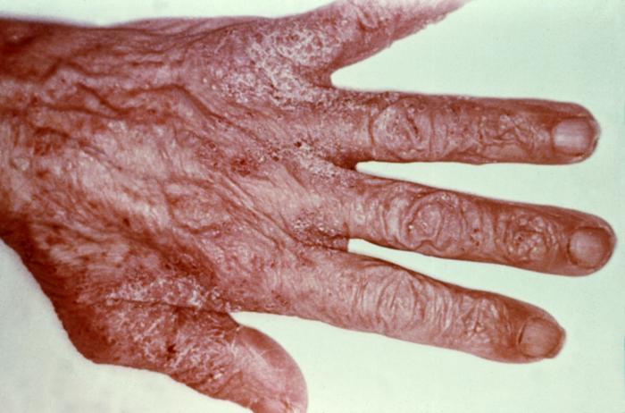 This patient’s hand reveals a scabies infestation of the mite species Sarcoptes scabiei var. hominis/CDC