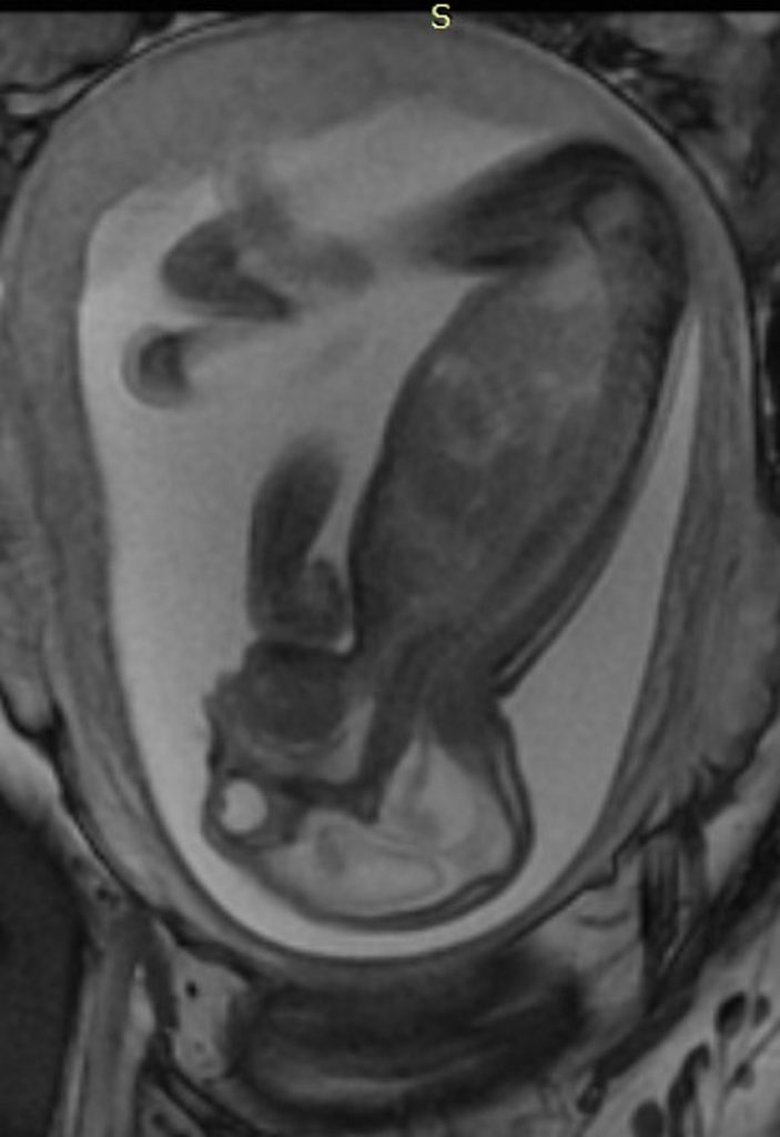 This is a side view of a fetus with hands and clubfeet (arthrogryposis), enlargement of the cerebral fluid space and dilation of cerebral ventricles. Thinning of the brain tissue, a poorly developed cerebellum and the absence of brain cortical gyri. Image/Radiological Society of North America