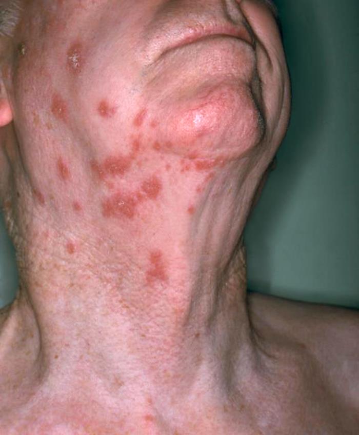 Produced by the National Institute of Allergy and Infectious Diseases (NIAID), this anterolateral view of this patient’s neck reveals the presence of an erythematous rash that had been attributed to a shingles