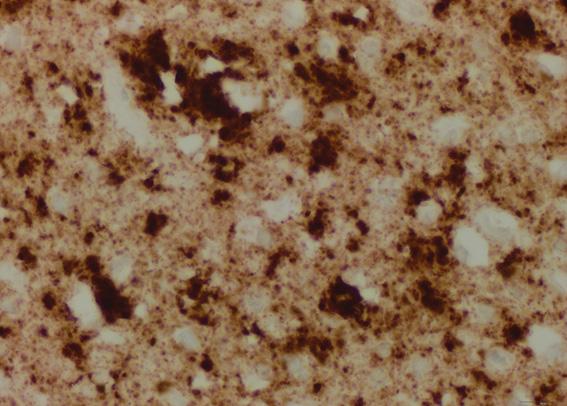 The brain of one patient who died from sporadic Creutzfeldt-Jacob disease (sCJD) appears nearly identical to the brain of a mouse inoculated with infectious prions taken from the skin of patients who died from sCJD. Image/Case Western Reserve University