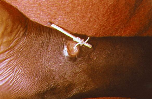 This image depicts a method used to extract a Guinea worm from the leg vein of a human patient. Image/CDC