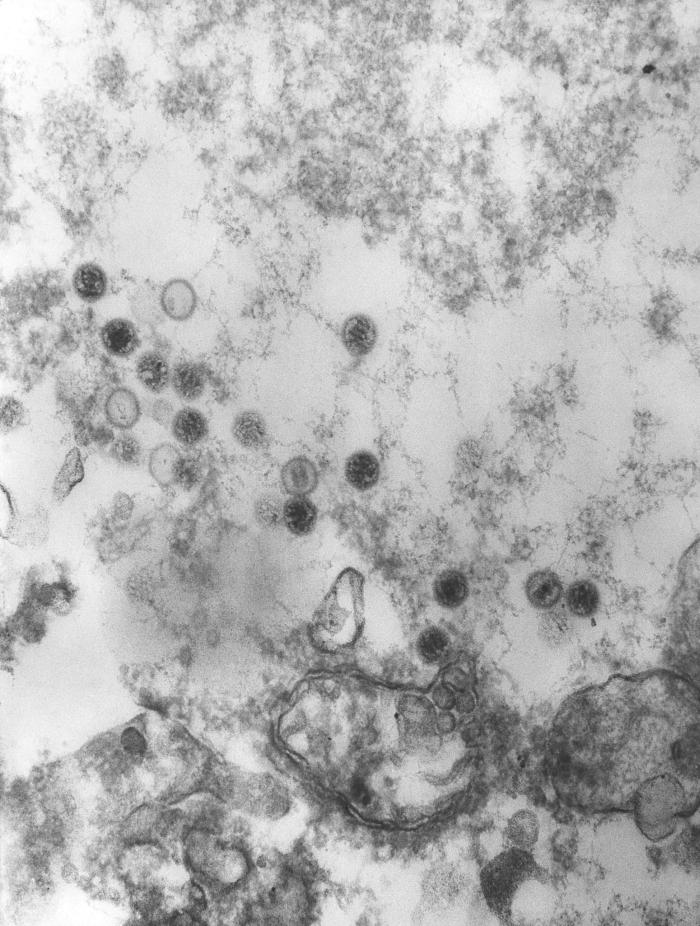 This transmission electron microscopic (TEM) image revealed the presence of numerous Epstein-Barr virus (EBV) virions/CDC