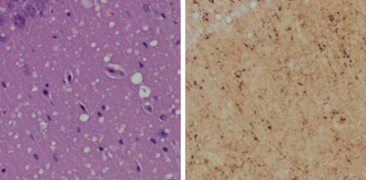 (Left) Staining shows spongiform degeneration. (Right) Staining shows intense misfolded prion protein. Image/Case Western Reserve University School of Medicine
